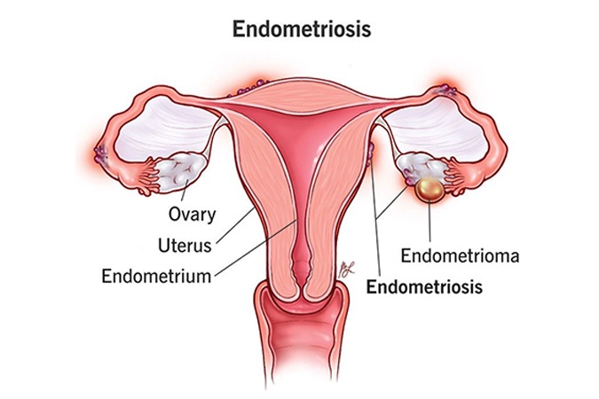 endometriosis-sypmtoms