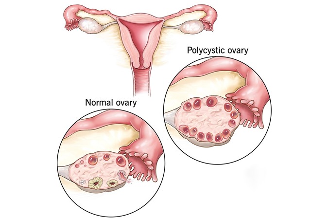 PCOS